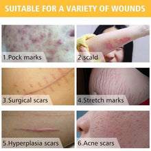 Load image into Gallery viewer, Home Laser Removal Pen for Tattoos Moles &amp; Blemishes
