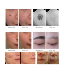 Load image into Gallery viewer, Home Laser Removal Pen for Tattoos Moles &amp; Blemishes
